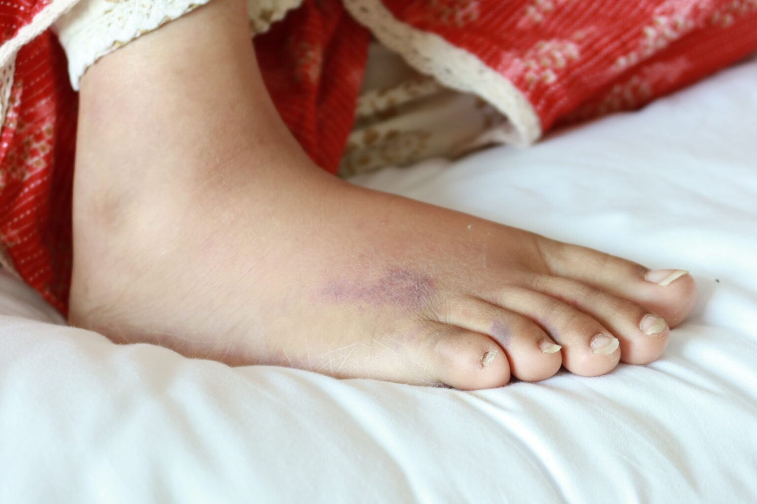 close up of women feet with swelling
