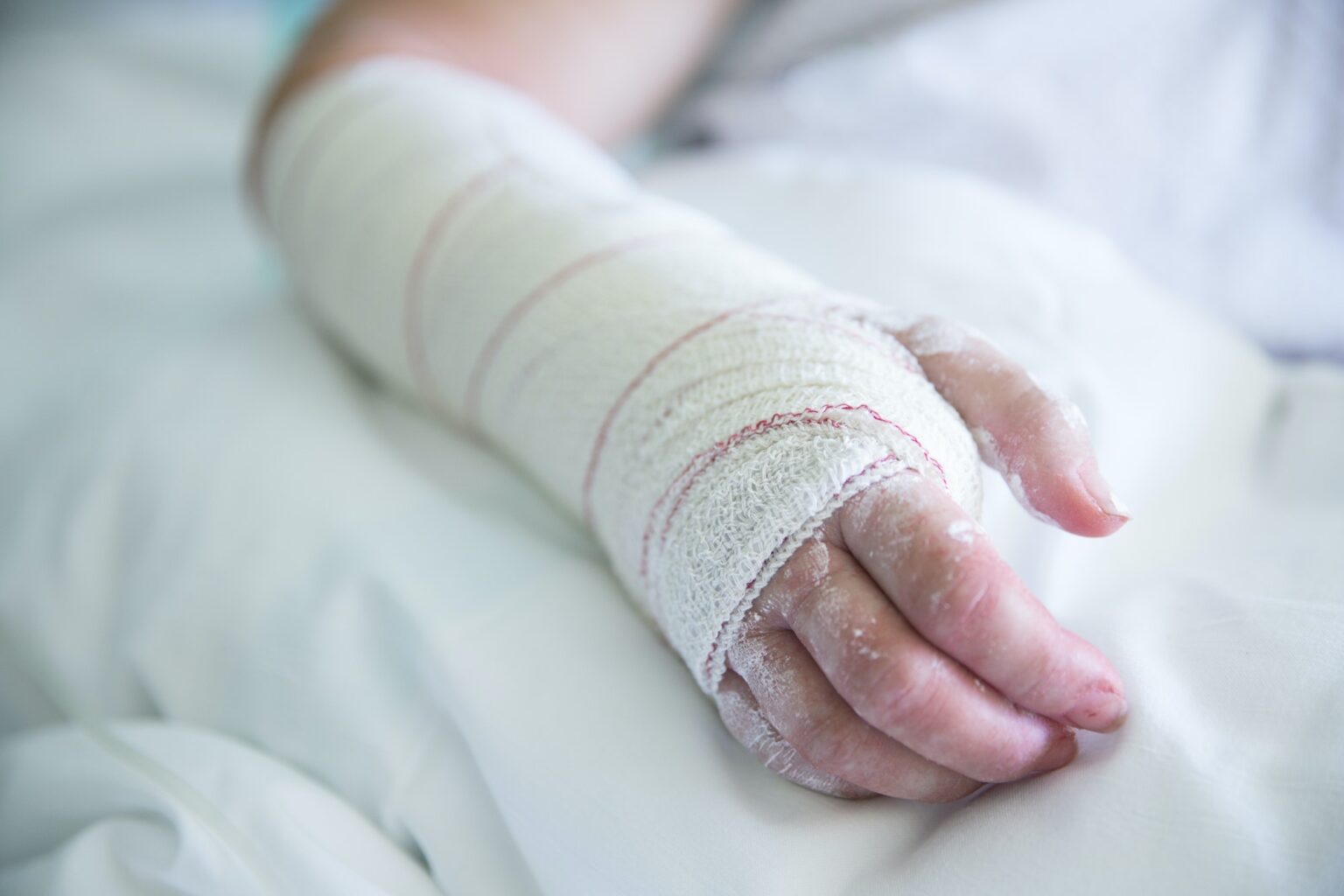 Woman in the hospital, operated hand