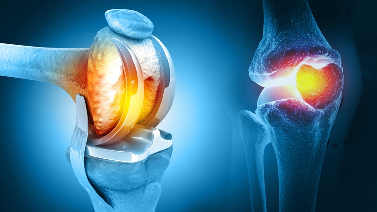 Human,Knee,Replacement,Surgery.,Knee,Joint,Treatment.,Knee,Injury.,3d