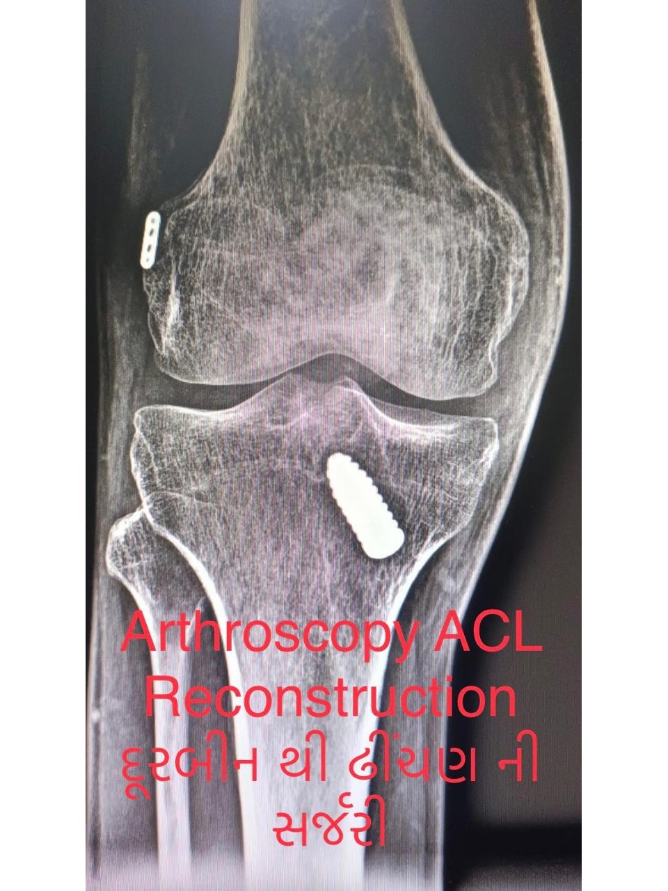 acl arthroscopy