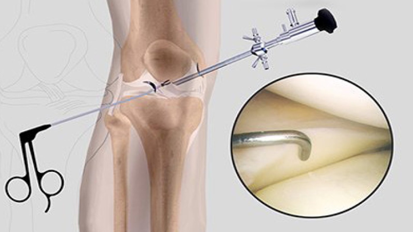 knee-arthroscopy (1)