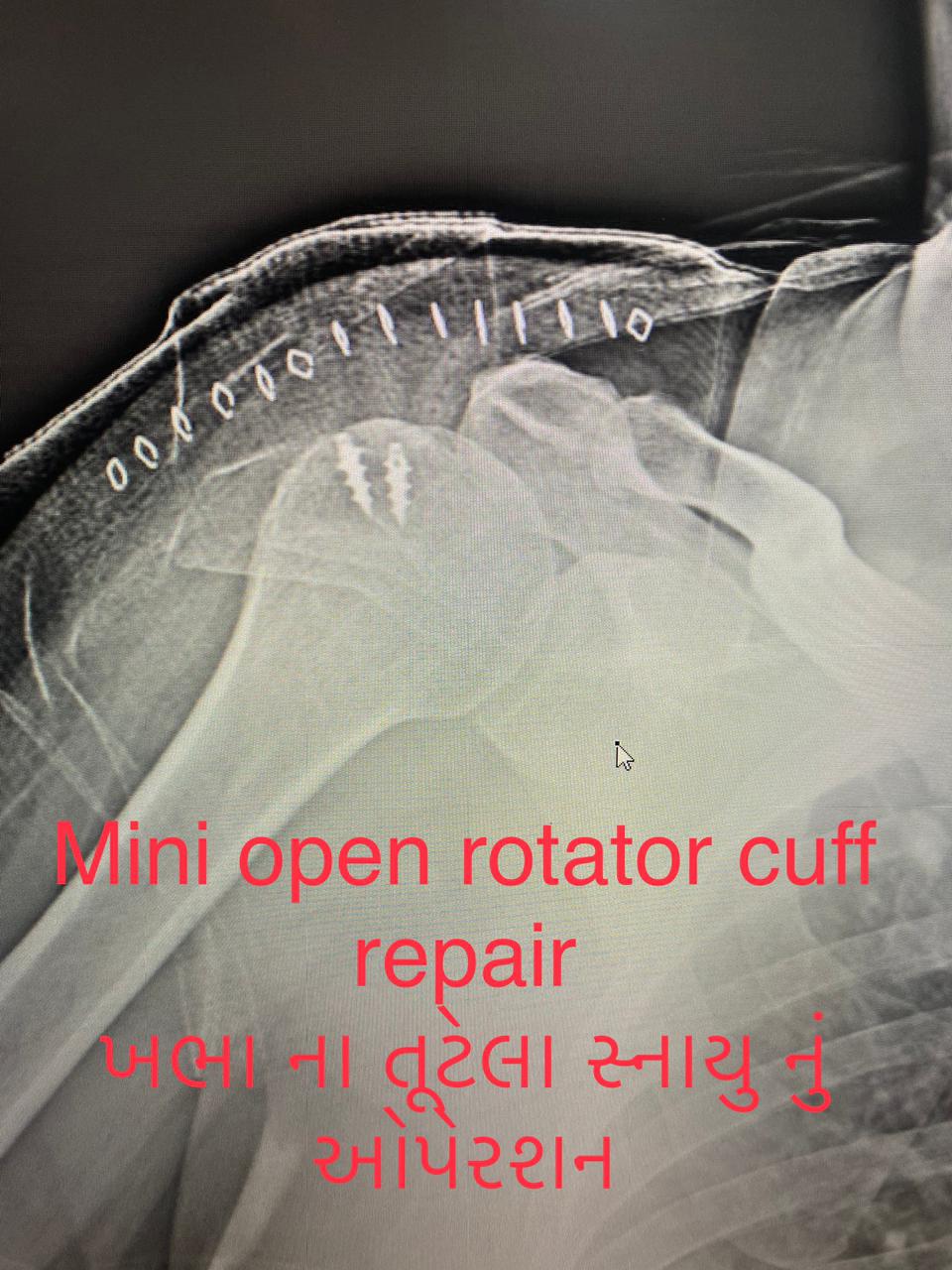 rotator cuff arthroscopy