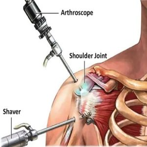 Arthroscopy-Shoulder