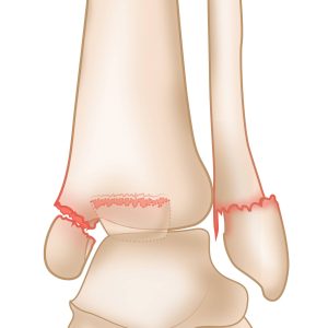 ankle_fracture_trimalleolar-01