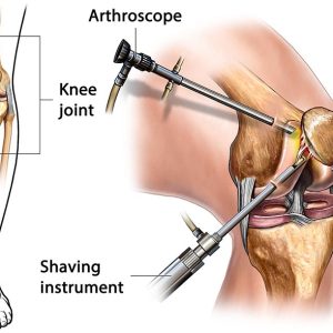 AARCPA Arthroscopic Knee Surgery